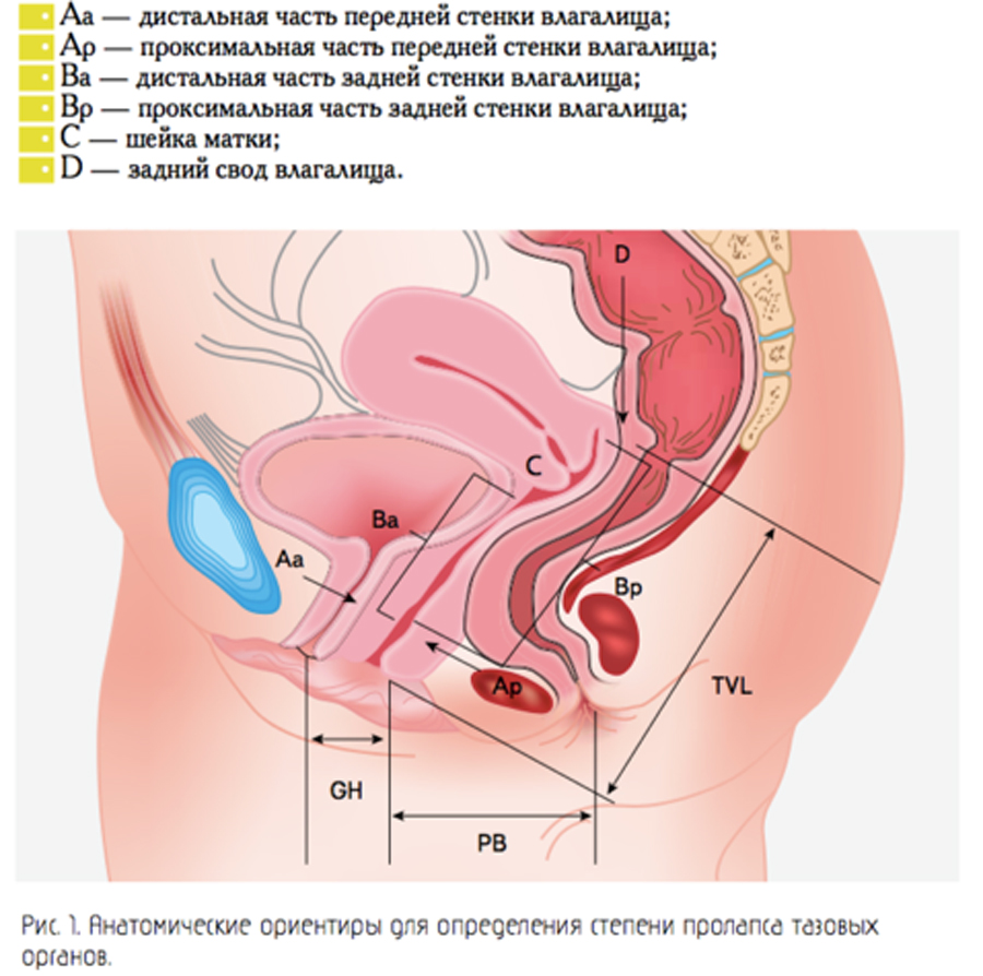Анатомические ориентиры для определения степени пролапса тазовых органов 